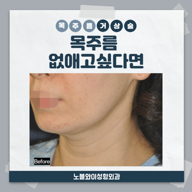 목주름거상술 가로, 세로목주름, 선천적목주름 등 개선가능