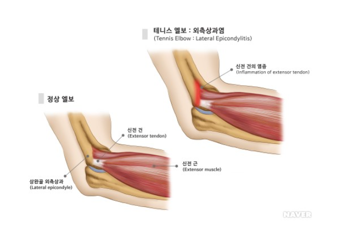  테니스 엘보우는 치료를 어떻게 할까요?
