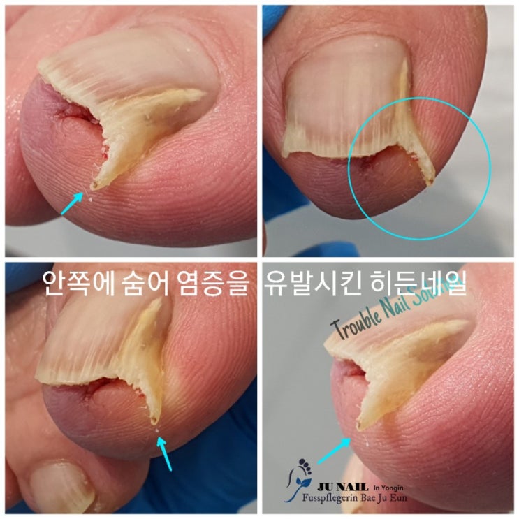 뾰족한발톱 파고드는발톱이 너무 아파요. 멀리 경북 문경에서 오신 할머님/분당용인수원수지보정동백죽전동/주네일/무좀파고드는내향성발톱손톱변형전문네일살롱