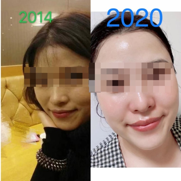  [르네셀] 다이아몬드필 사용후기/ 효과