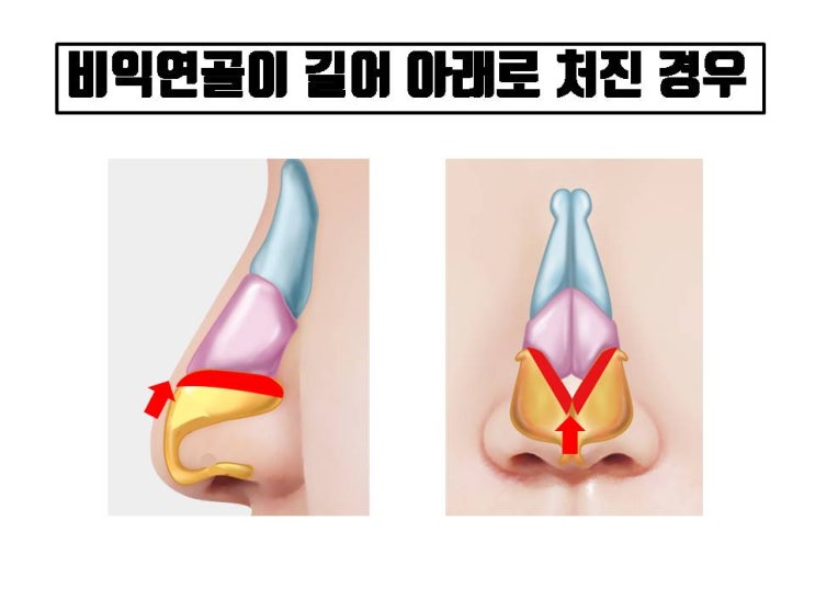  화살코 코성형, 코보형물 없이 자가 연골로만 교정할 수 있어요!!!
