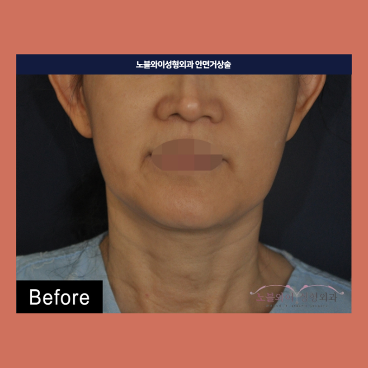  안면거상술잘하는병원 회복기간 어떨까