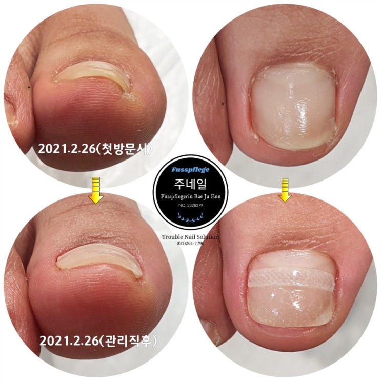 신발신고 걸을때 엄지발톱이 아파요./분당용인수원수지보정동백죽전동/주네일/무좀파고드는내향성발톱손톱변형전문네일살롱 신발신고 걸을때 엄지발톱이 아파요./분당용인수원수지보정동백죽전동/주네일/무좀파고드는내향성발톱손톱변형전문네일살롱