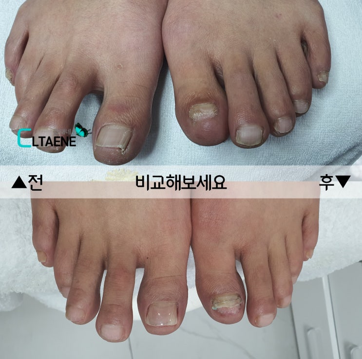  내성발톱 교정 문제성발톱 부천 어딕션네일 BAEHR 전문케어샵