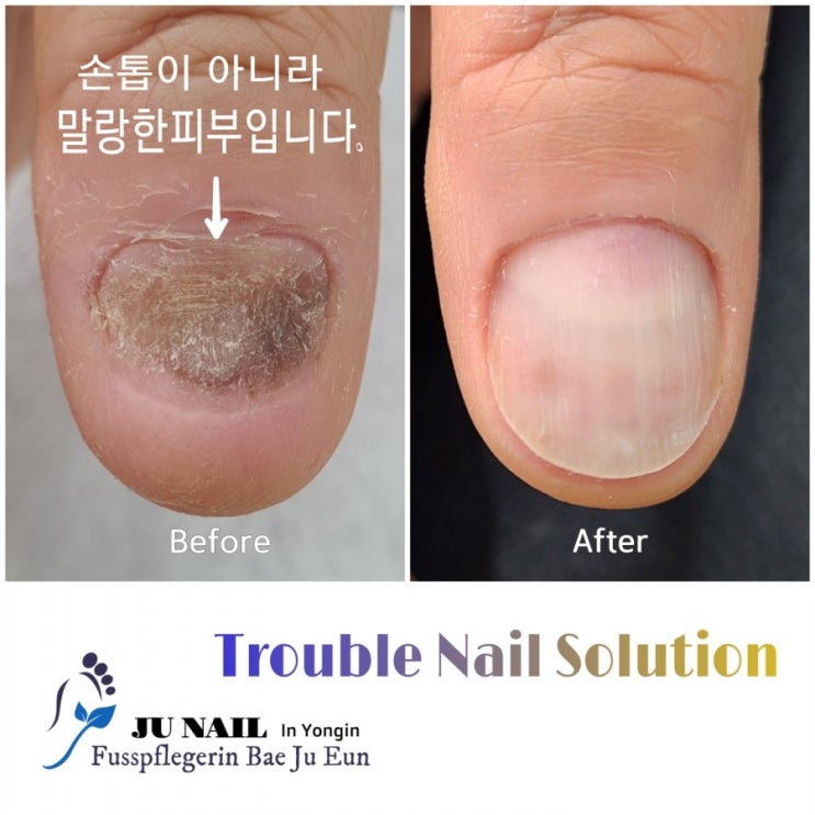문에끼어 다친 엄지손톱이 변형되고 자라지않아요.(놀람주의)/분당용인수원수지보정동백죽전동/주네일/무좀파고드는내향성발톱손톱변형전문네일살롱 문에끼어 다친 엄지손톱이 변형되고 자라지않아요.(놀람주의)/분당용인수원수지보정동백죽전동/주네일/무좀파고드는내향성발톱손톱변형전문네일살롱