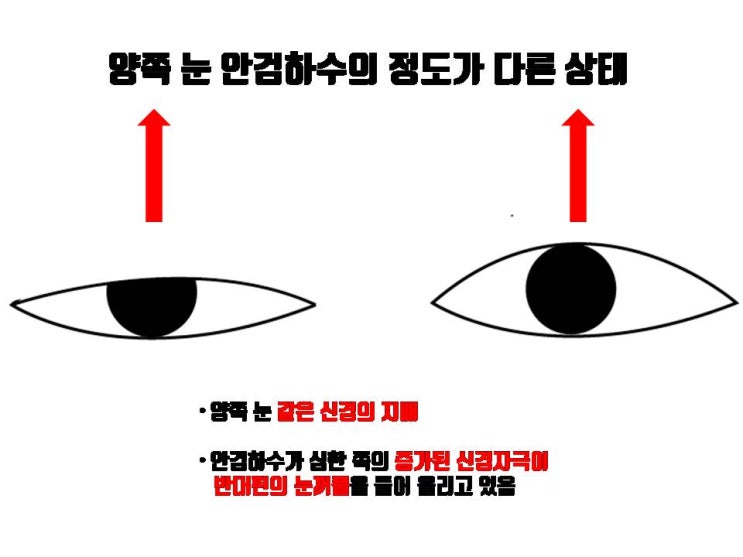  안검하수의 정도가 차이 난다고 작은 눈만 눈매교정 하면 큰 눈이 더 작아져요!!! (헤링의 법칙)