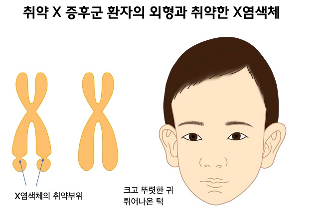 파타우증후군취약X증후군 에드워드 다운 증후군 원인 특징