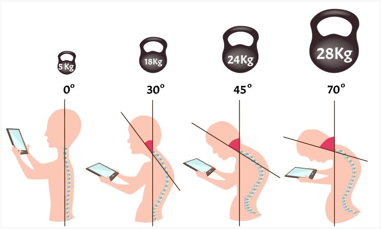 역C자목 교정, 이것 모르고 치료하면 신경마비 온다?
