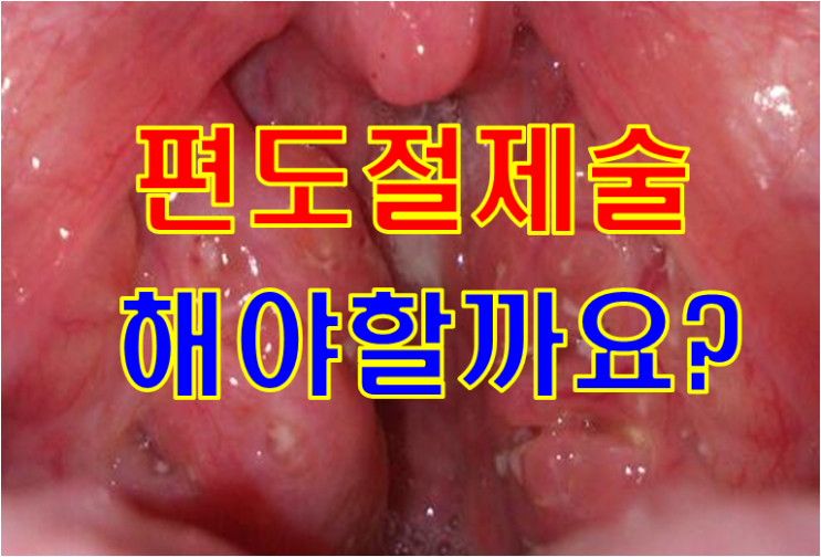  편도염, 편도결석으로 고생하는 22세 여자 - 편도절제술 꼭 해야하나요?