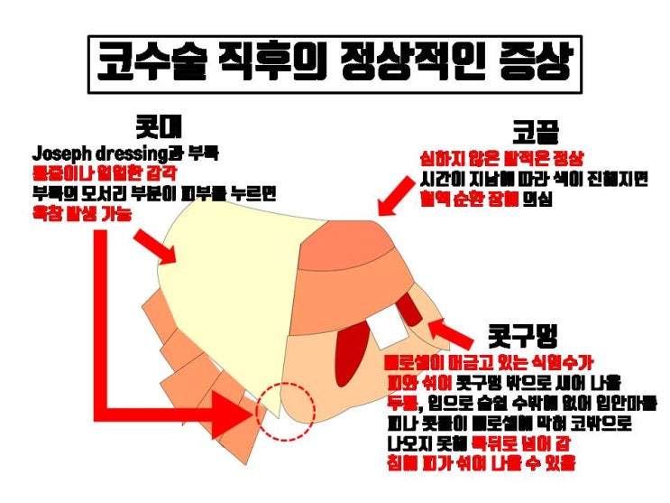  코수술 후 코끝이 빨개지기만 해도 걱정되시죠? 코수술 후 나타날 수 있는 모든 증상들 알려 드려요