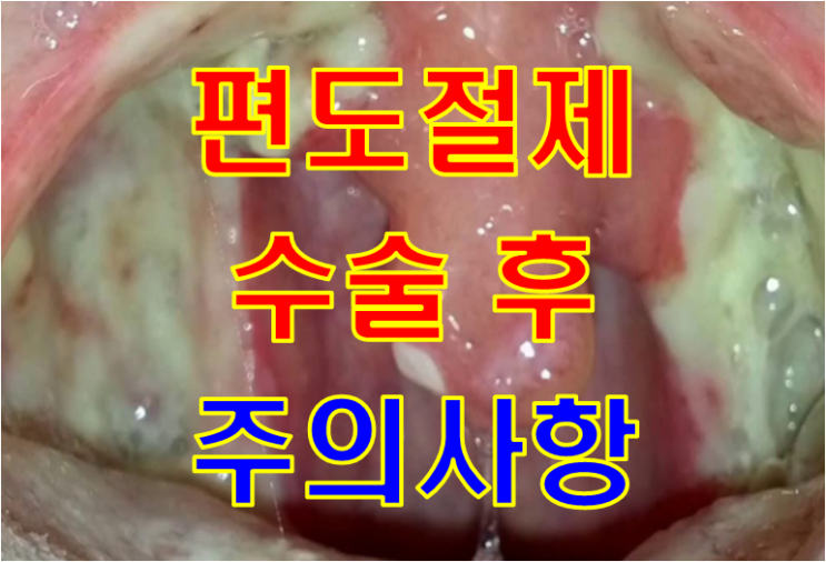  편도염, 편도결석으로 고생하는 22세 여자 - 수술 이후에 꼭 지켜야할 주의사항은 어떤게 있나요?
