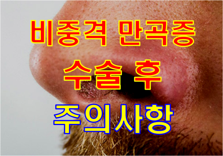 비중격만곡증 수술 받은 30대 직장인 - 수술후 꼭 지켜야할 주의사항은 어떤게 있나요?