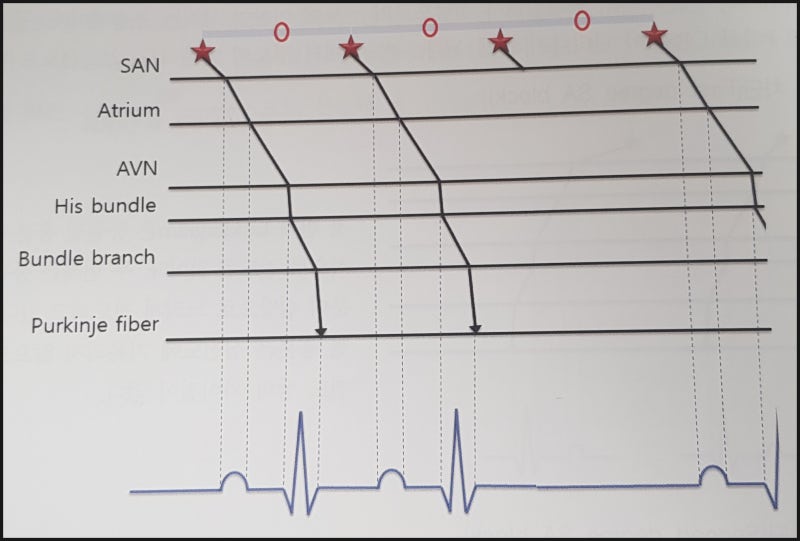 동방 차단 (SinoAtrial block ; SA block) : 네이버 블로그