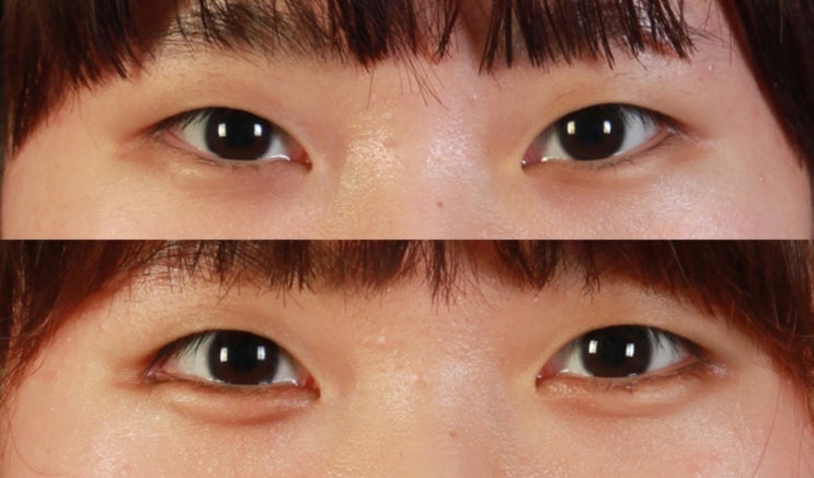  부작용 없는 반 영구적인 진피 애교 수술