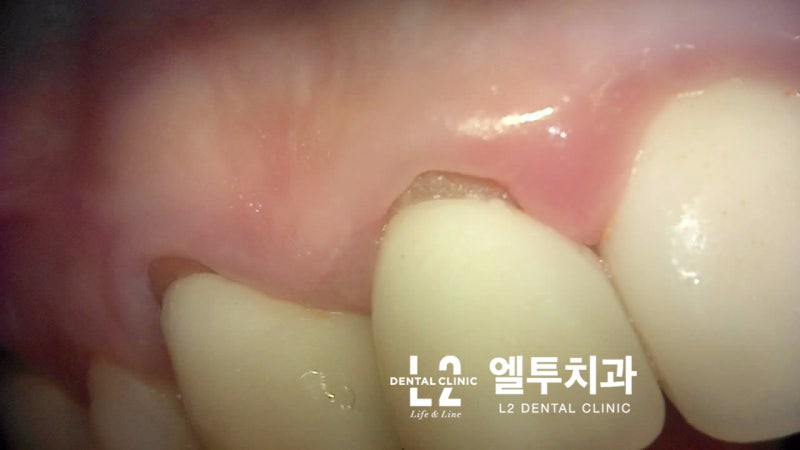 치은염의 고름에 대처하는 방법 5