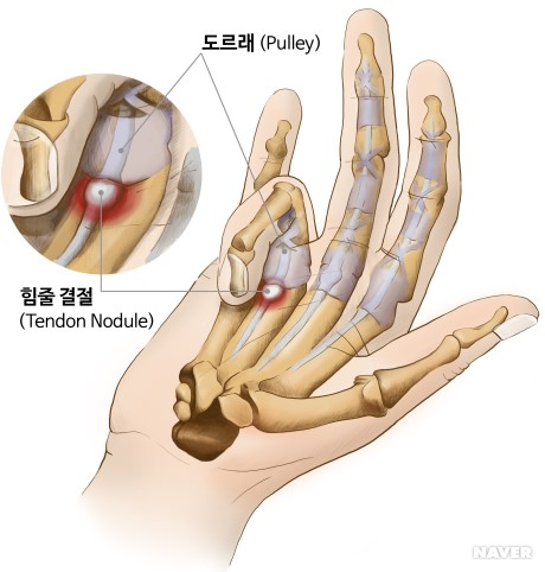  손가락이 안 굽혀져요, 손가락 통증, 방아쇠수지