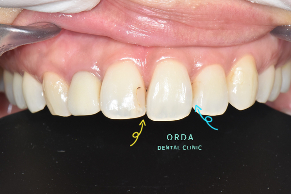 반월동 치과, 레진 변색  앞니 치료 살펴보기