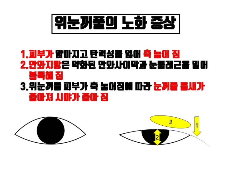  쌍수 후 시간이 지나면 쌍꺼풀은 낮아지는 걸까요?