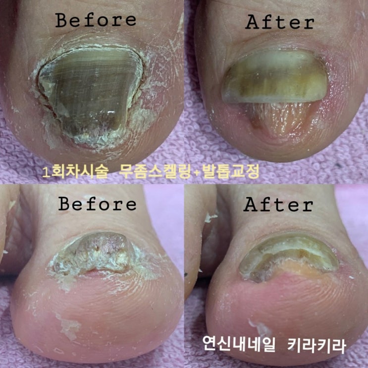  [키라키라]연신내네일 은평구내성발톱 은평구발톱무좀 동시에 잡자!!!