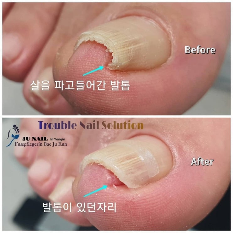 엄지발톱 통증과 함께 발톱이 파고 들어요./분당용인수원수지보정동백죽전동/주네일/무좀파고드는내향성발톱손톱변형전문네일살롱 엄지발톱 통증과 함께 발톱이 파고 들어요./분당용인수원수지보정동백죽전동/주네일/무좀파고드는내향성발톱손톱변형전문네일살롱