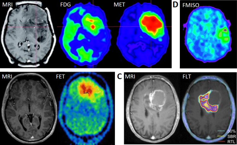 악성 뇌종양(Overview of Malignant Brain Tumor) : 네이버 블로그