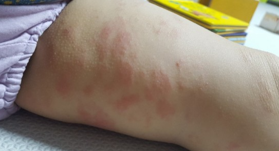  피부 알레르기발진 변화 후기