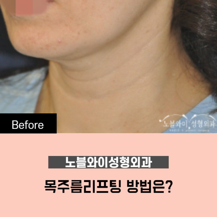 노블와이성형외과 목주름리프팅 방법은