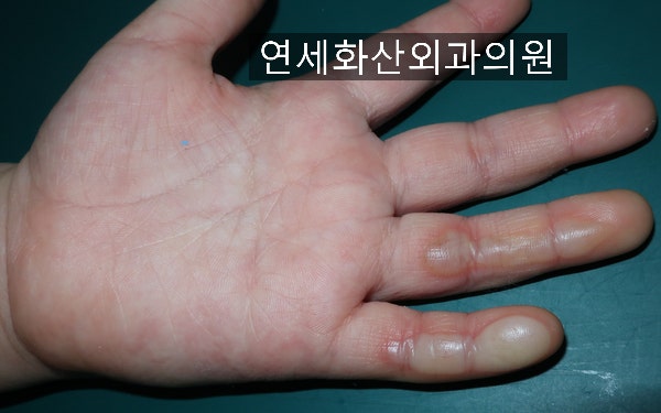 [송파 광진 화상치료 -- 연세화산외과의원] 고기 불판을 짚어서 생긴 아이 손가락 화상의 치료 - 표재성 2도 화상 : 네이버 블로그
