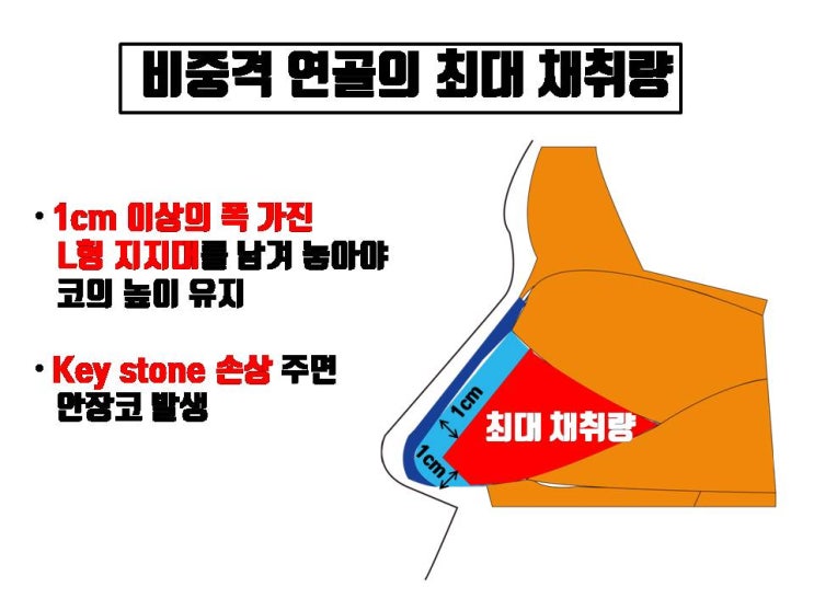  코수술 시 비중격 연골이 부족한지 여부는 수술해 보지 않고는 절대 알 수 없어요!!!