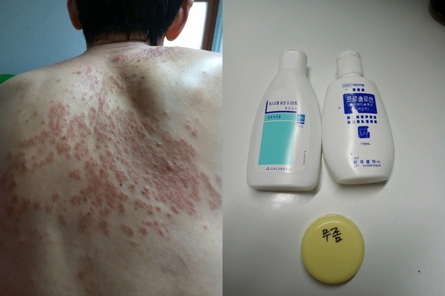 "중증 피부병에 무좀약?" 청주 모 요양원 입소자 방치 논란 "중증 피부병에 무좀약?" 청주 모 요양원 입소자 방치 논란
