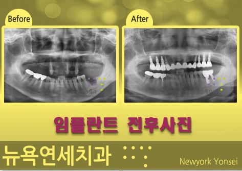  어금니 임플란트 수술 전후 사진 입니다.