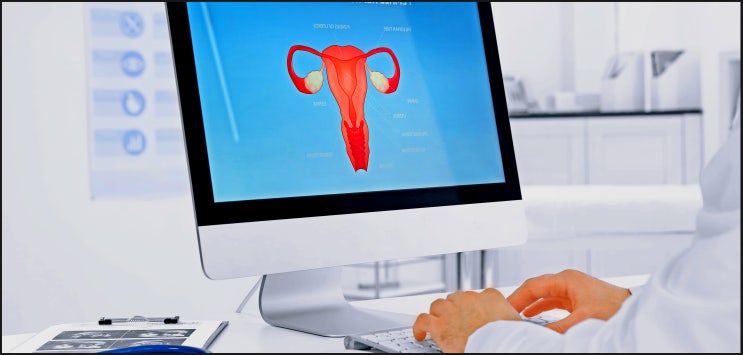  난소낭종 자궁내막증, 젊다고 안심하다간 불임된다?