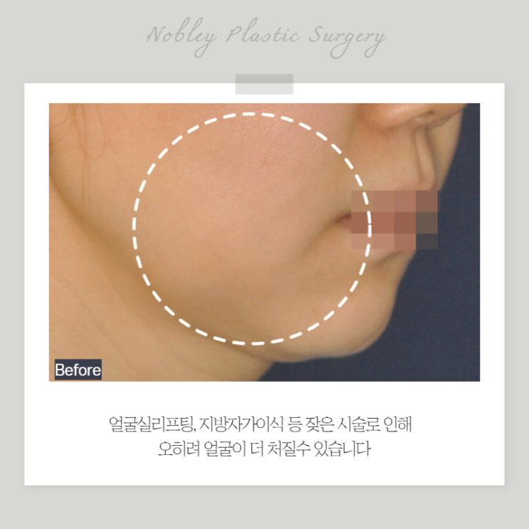  안면거상수술 얼굴실리프팅 같은 시술 받았는데도 가능할까