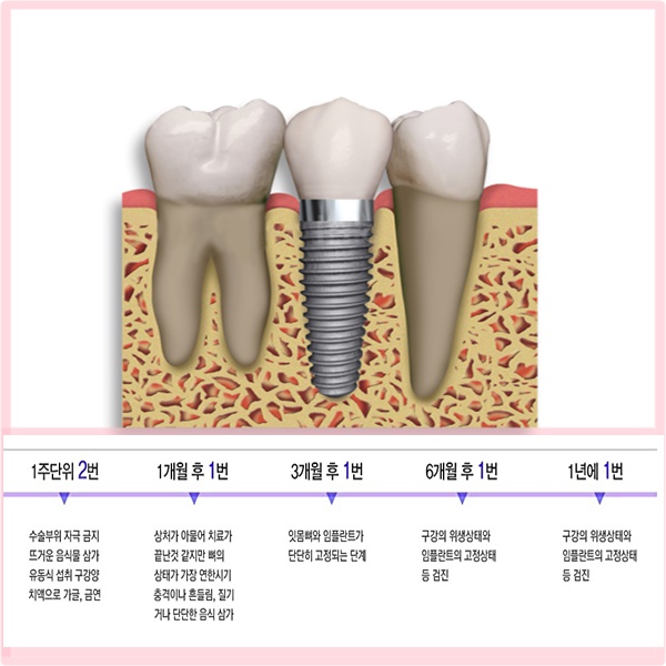  임플란트 수술후 치과 꼭 가야 하나요?