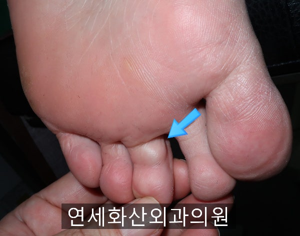 <용인수지 손목결절종> 비수술 손목결절종 치료 도침요법 재호한의원