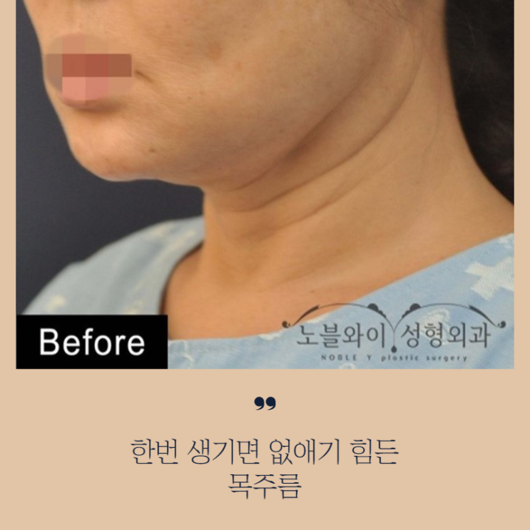  목주름성형 유지기간이 오래가