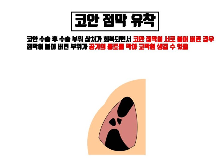  이비인후과에서 받은 코수술이 성형외과에서 받을 코성형에 미치는 영향은 막대!!!