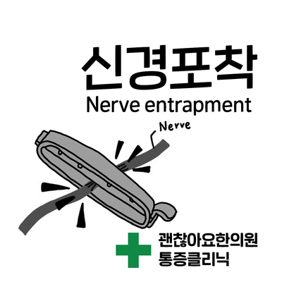 발저림 손저림. 저리고 시리고 찌릿찌릿한 통증. 신경포착 증후군 (Nerve entrapment syndrome) 발저림 손저림. 저리고 시리고 찌릿찌릿한 통증. 신경포착 증후군 (Nerve entrapment syndrome)