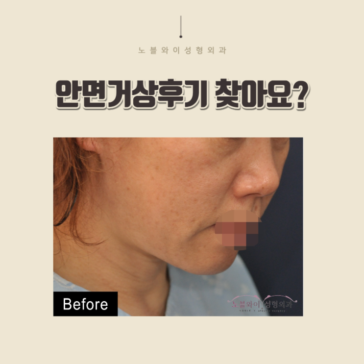  안면거상후기 보니 잘하는곳 맞네