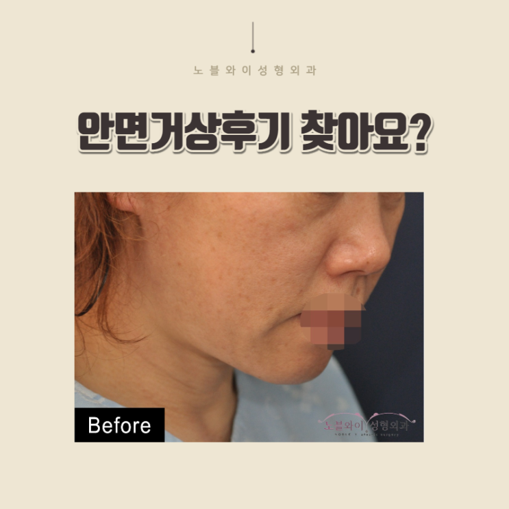 안면거상후기 보니 잘하는곳 맞네