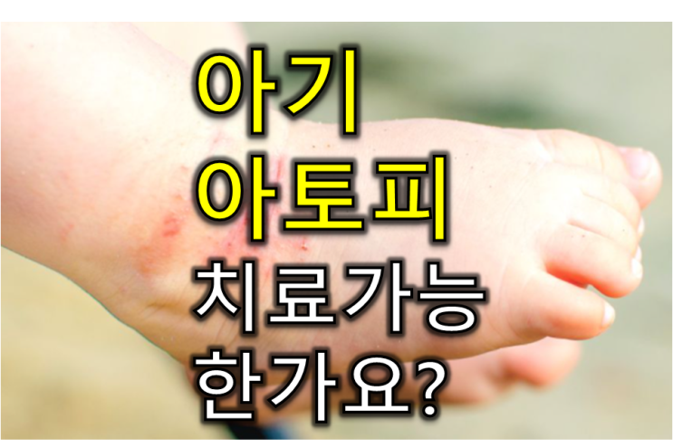  온몸을 긁는 12개월 아기 - 아기 아토피, 치료 가능한가요?