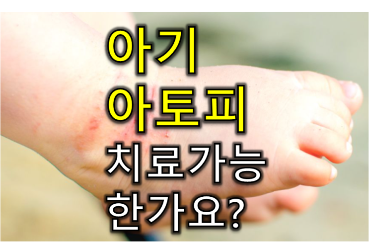 온몸을 긁는 12개월 아기 - 아기 아토피, 치료 가능한가요?