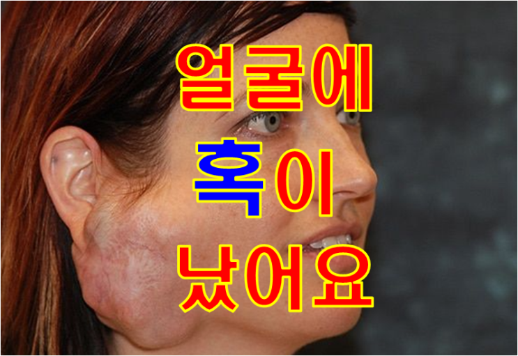  얼굴에 혹이 만져지는 45세 여자 - 침샘종양, 이하선종양, 턱밑샘종양