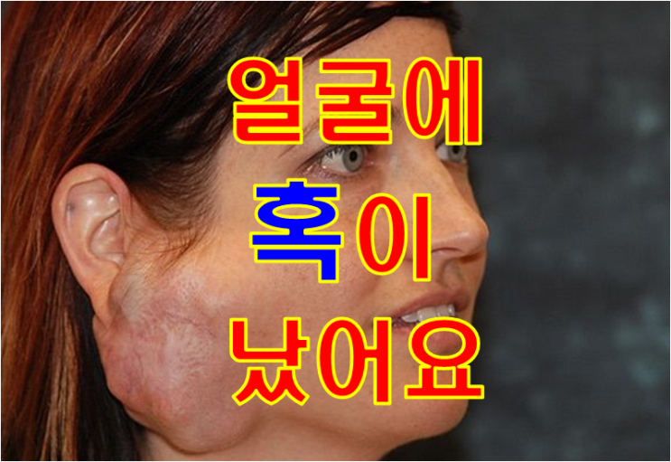 얼굴에 혹이 만져지는 45세 여자 - 침샘종양, 이하선종양, 턱밑샘종양