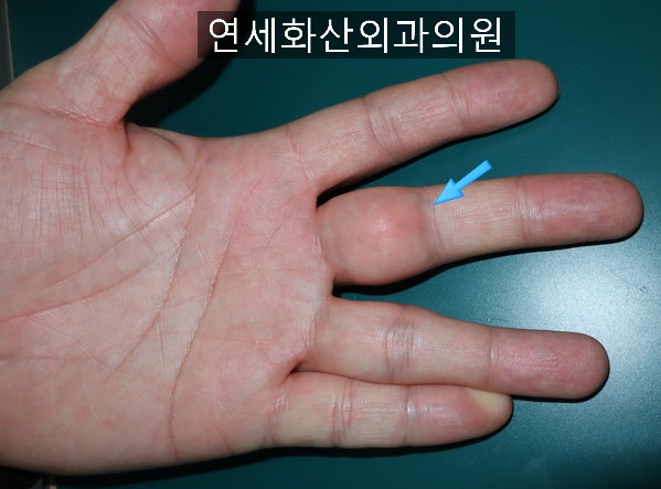 [송파 피부종양 수술] 손가락에 8