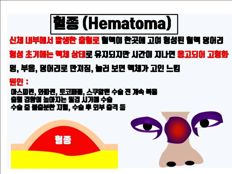  코수술 후 피고임, 대수롭지 않게 생각하면 코수술 부작용으로 혼쭐나요!!!