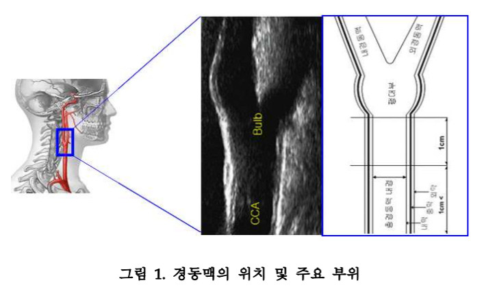 경동맥 초음파 - IMT (경동맥 내중막 두께) 재기