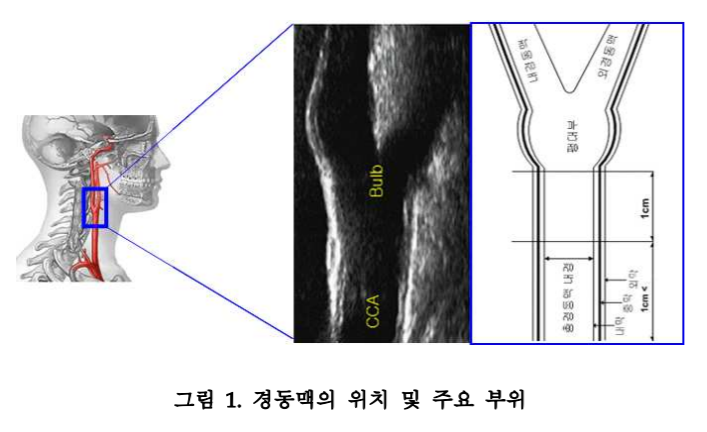  경동맥 초음파 - IMT (경동맥 내중막 두께) 재기