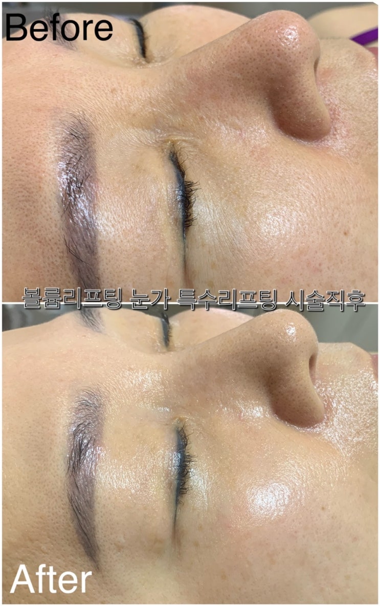  수완지구 피부관리 디어페이스 물방울리프팅 리얼 후기!