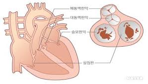 판막질환케이스공부 승모판탈출 대동맥협착 삼첨판폐쇄 폐동맥판막 원인증상 약물치료